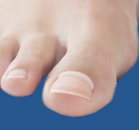 Onyfix Nail Correction