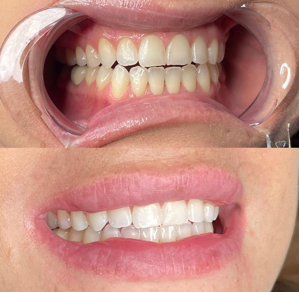 Teeth Whitening (30 Min)