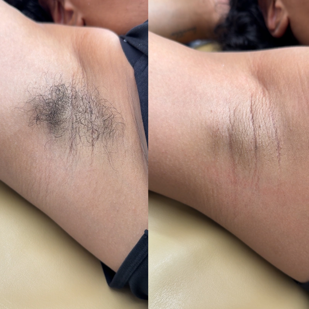 Underarms at Classic Waxing Co in La Habra, CA