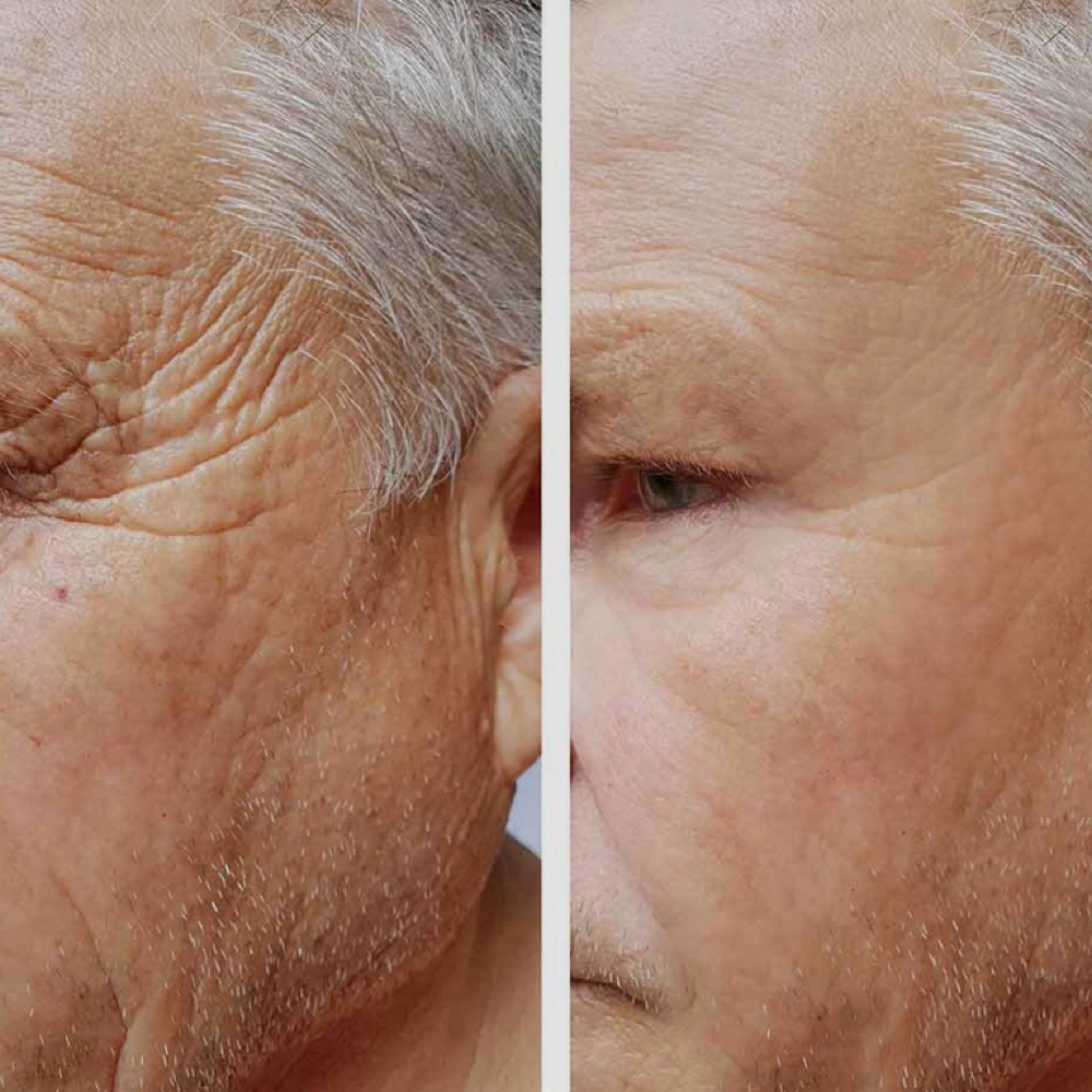 Microneedling Anteaging Fine Lines at Organic Beauty By Eve in Garden City, NY