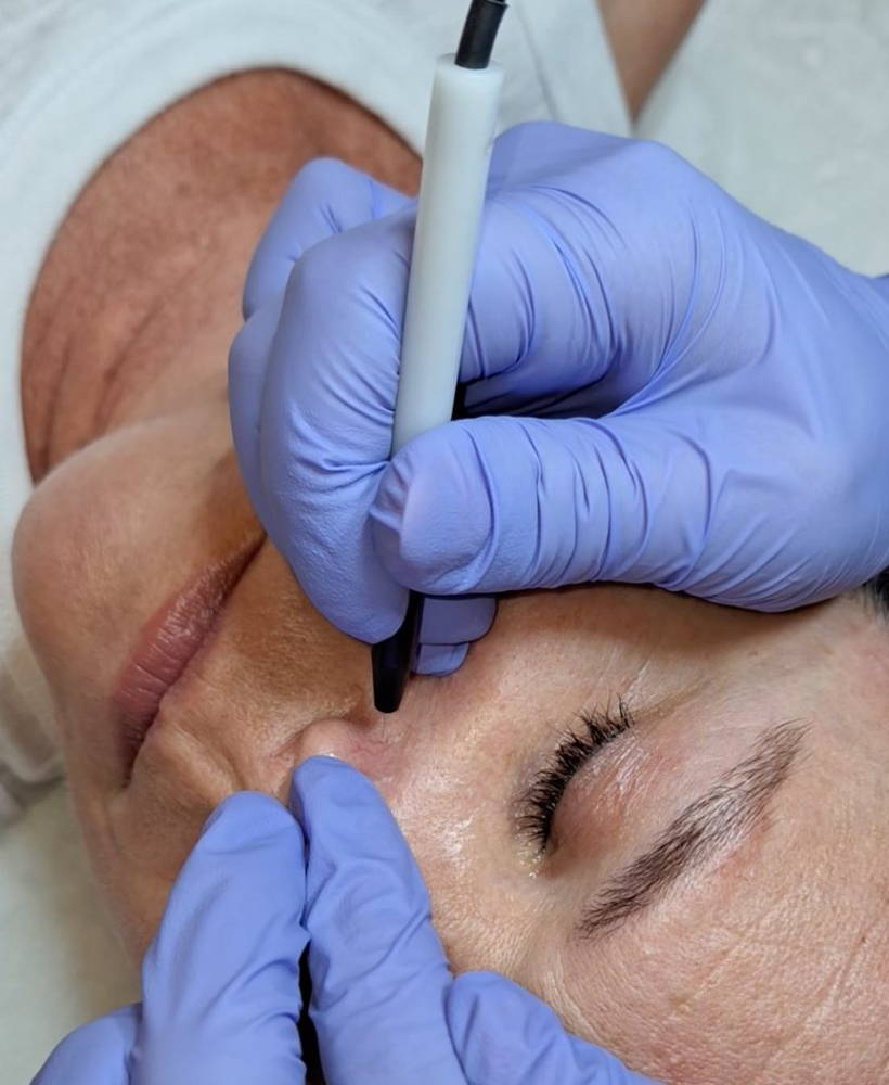 Skin Classic, Skin Tags, Cappilarie