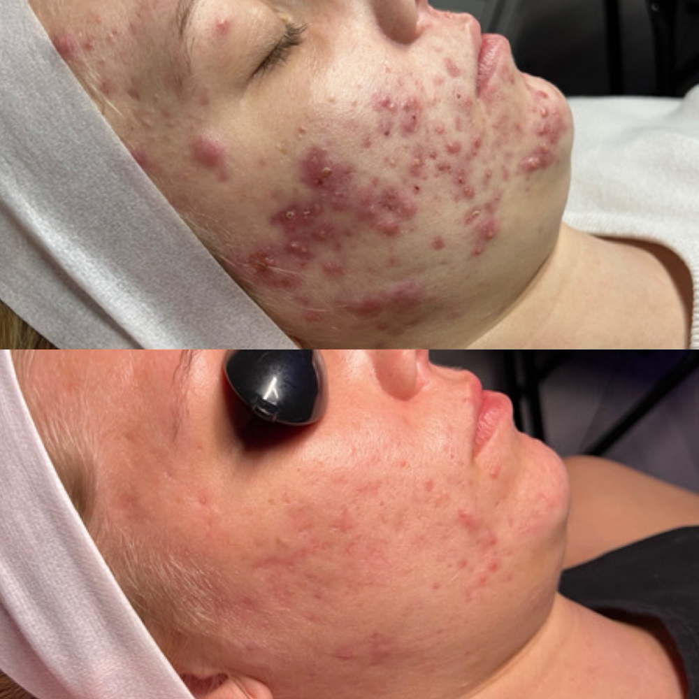 Acne Bootcamp Consult + Treatment at Love Yourself By Jeni in Kingwood, TX