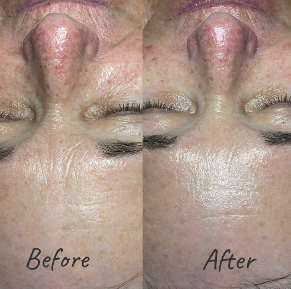 Rezenerate Nano Infusion Facial at Belle Vie Esthetics in Acworth, GA