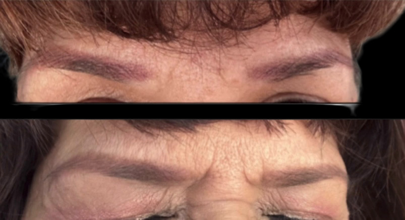 Saline Tattoo Removal