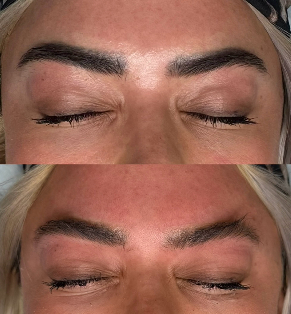 Laser Tattoo Removal PROMO 4x4