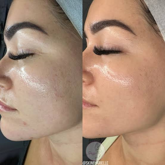 Advanced Exfoliation - TCA peels at Natural Glow in Grand Praire, TX