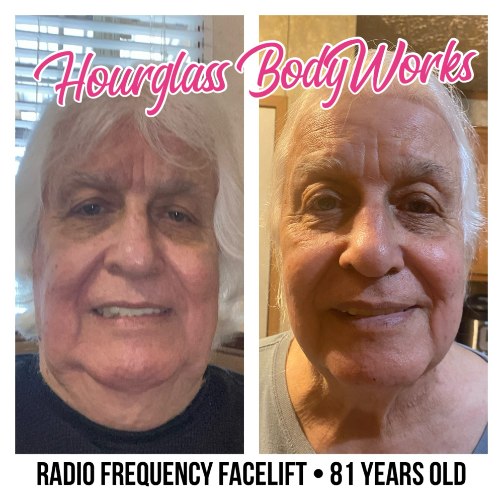 Radio Frequency Neck Tightening