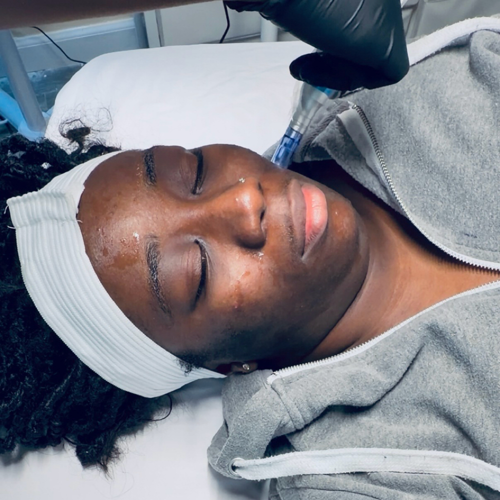 Microneedling Corrective Duo at Refinery Aesthetics Loft in Oxon Hill, MD