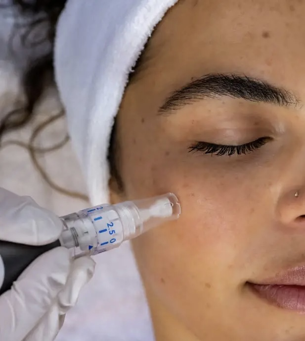 Nano Needling at Anna Kuhn in Westerville, OH