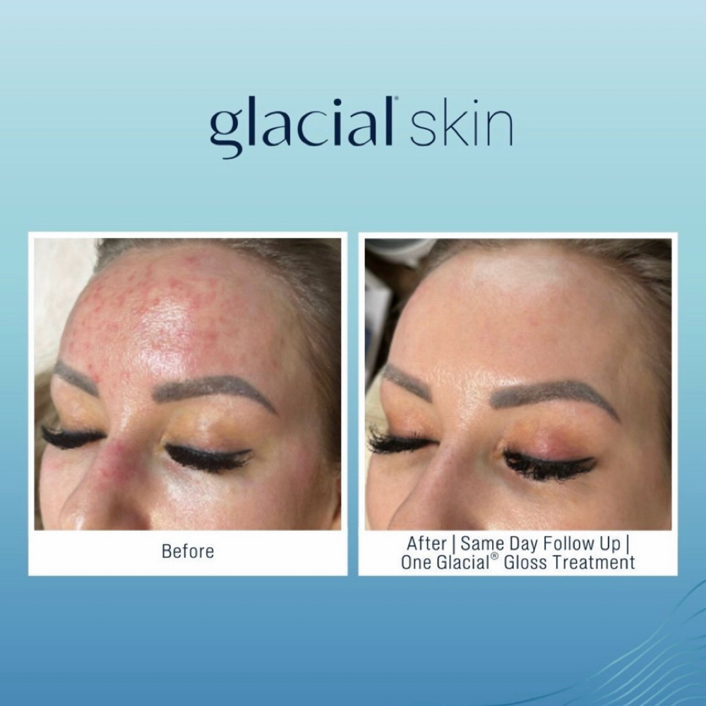Glacial Gloss Treatment at SKIN CLINIC in Laguna Hills, CA