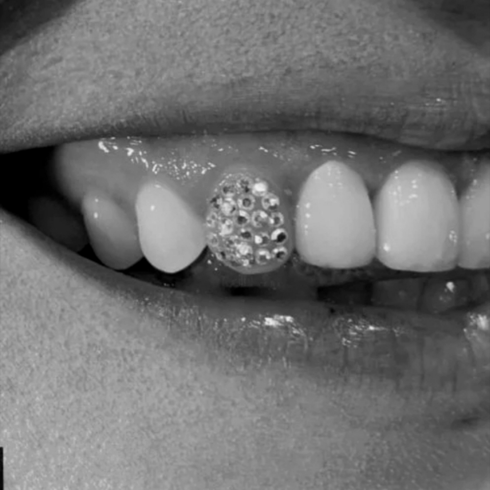 Tooth Gem Design: Disco Ball at The Neon Door in Tucson, AZ