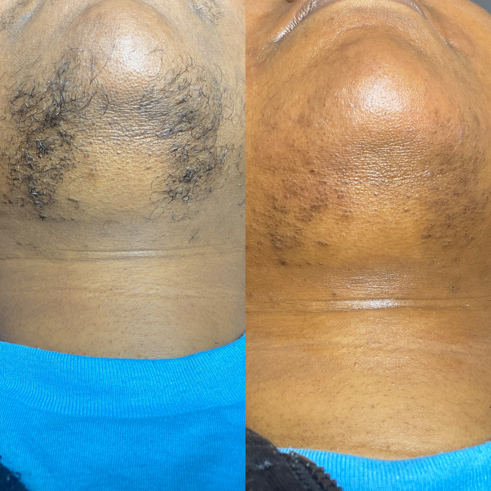Chin Wax