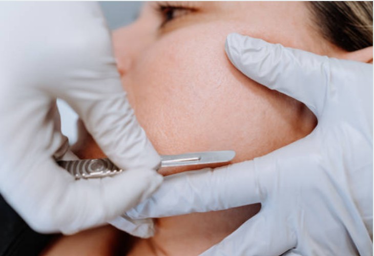 Facial Dermaplaning