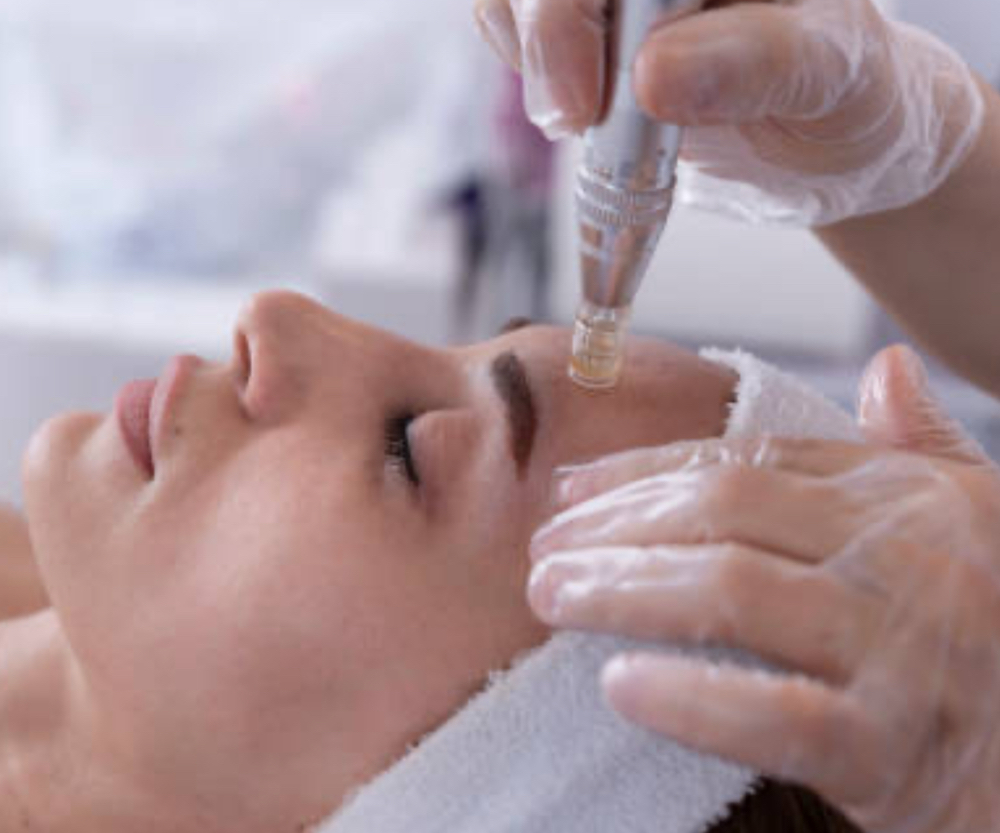 Micro-needling facial at IM Denver Skin LLC in Denver, CO