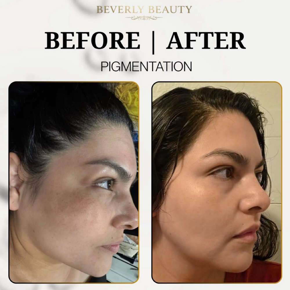 Luminous Tone Renewal Peel at Beverly Beauty Skincare and spa in Chicago Il, IL