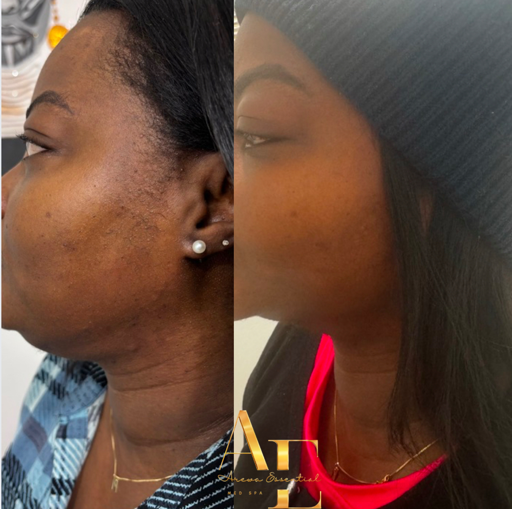 Chin Fat Dissolver at Arewa Essential Medspa in Mamaroneck, NY