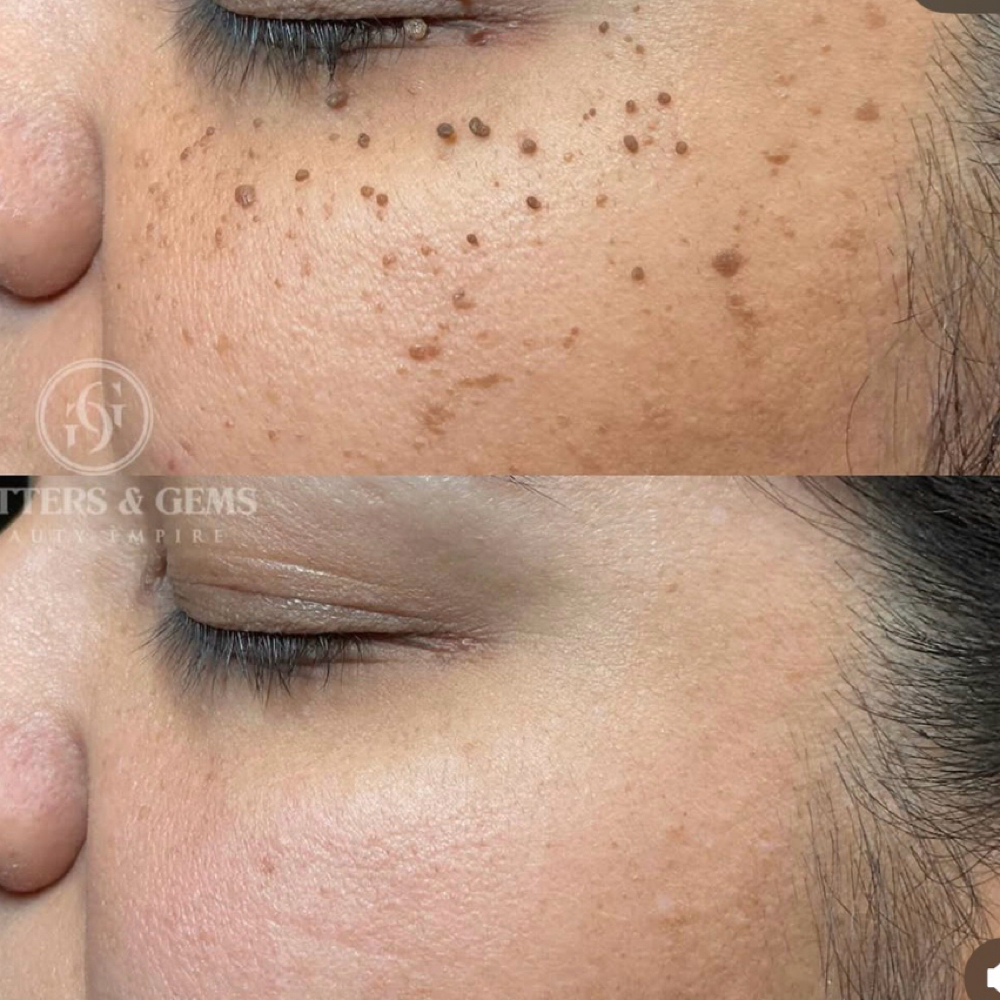 DPN Removal at Prestigious Butterflies in Rocky Mount, NC