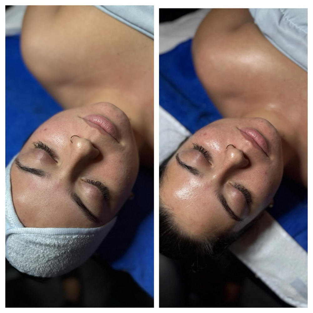 Oxygen Rx Treatment