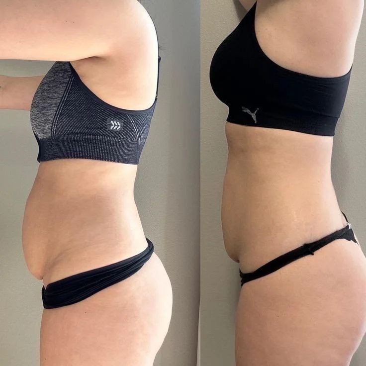 Body Sculpting at Lotus Beauty Center LLC in Eagle Pass, TX