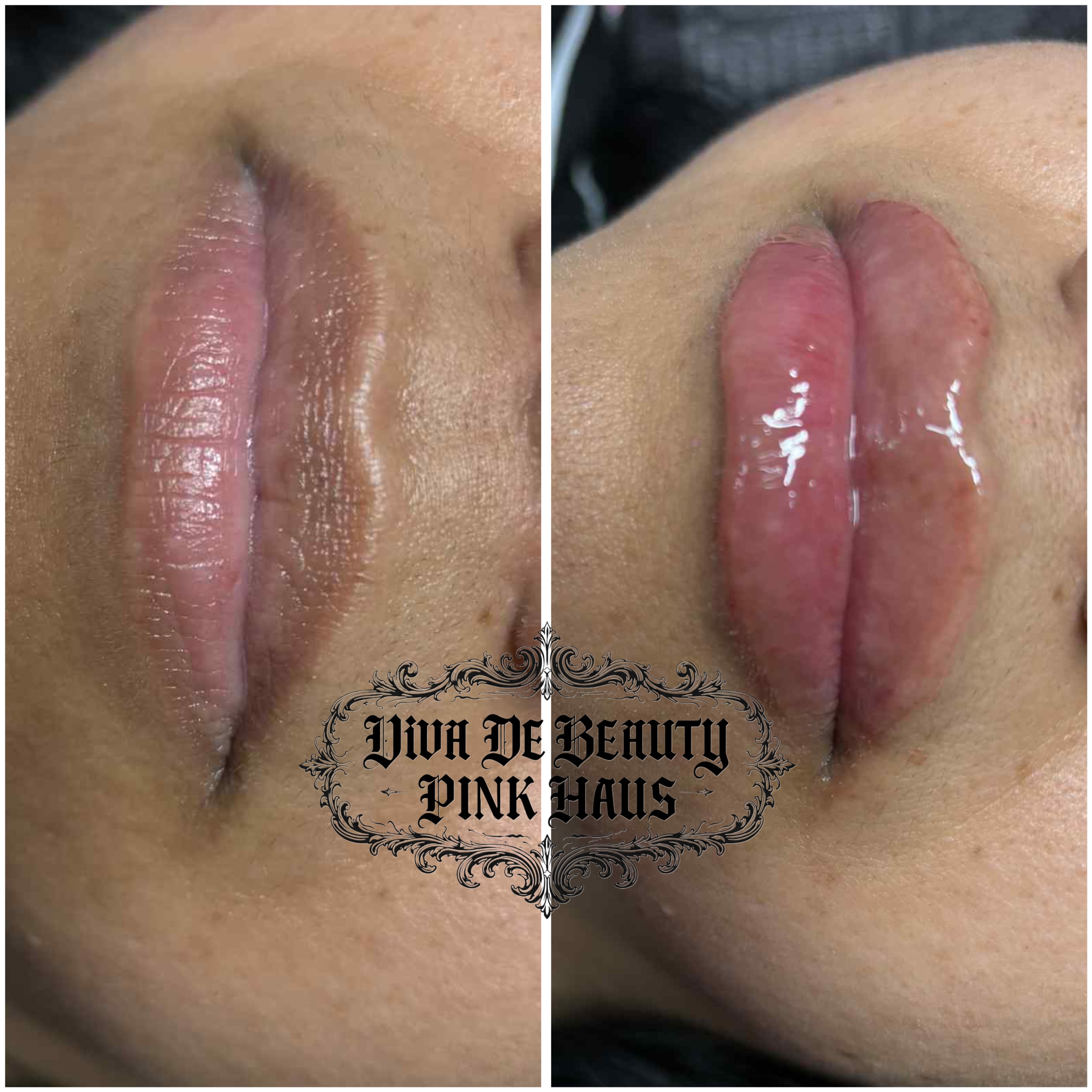 1/2 SYRINGE MicroNeedle Lip Filler at Viva De Beauty Pink Haus in Arlington, TX