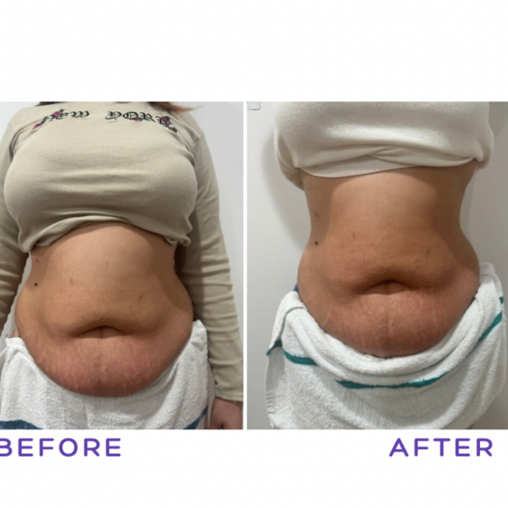 Body Cavitation/lipo/RF/ wood thera at Pure skin by Kat in Newtown, CT