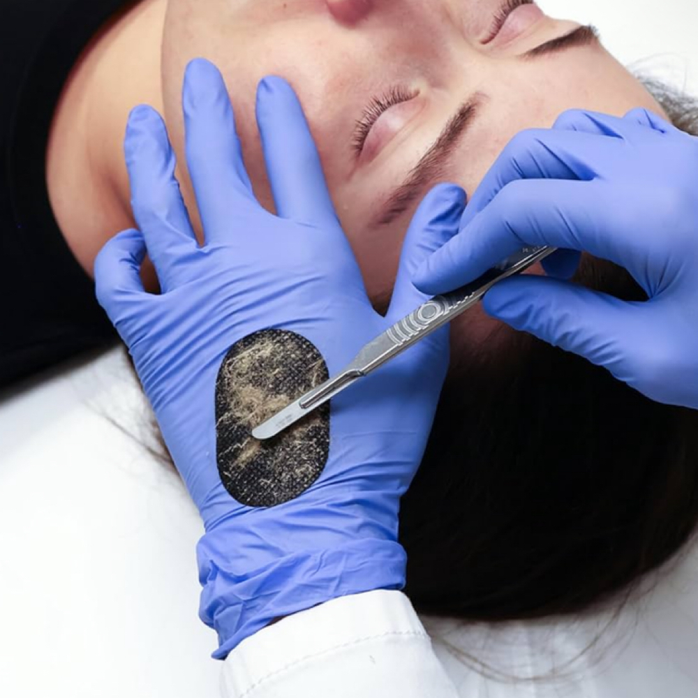 DermaPlane Facial at Adarable Esthetics LLC in Taunton, MA