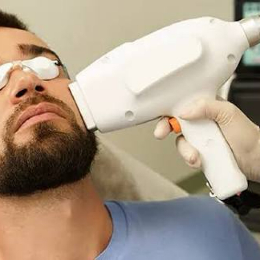 Laser Hair Removal (Beard Area)