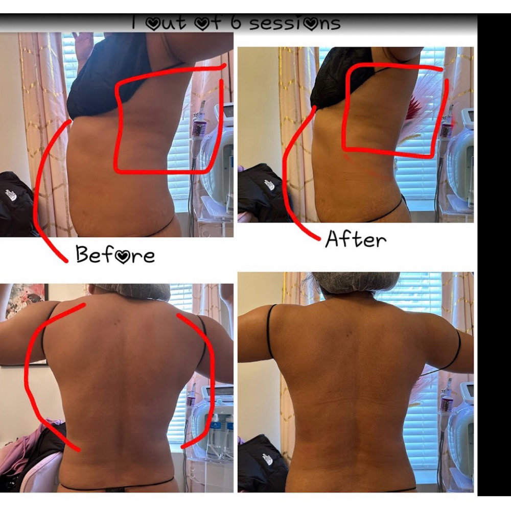 Back & bra bulge 3-session bundle at Silhouette Body Sculpting LLC in St. Peter’s, MO