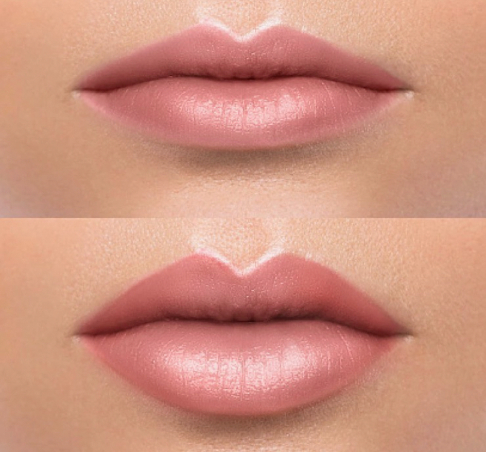 Lip/Facial Fillers