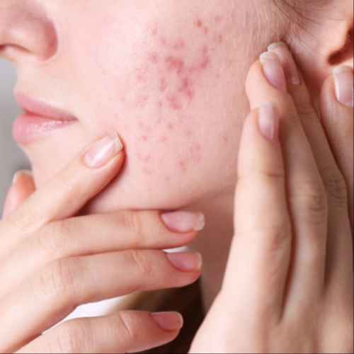 Acne Refinement Facial at Tracy WellBeing Retreat in Tracy, CA