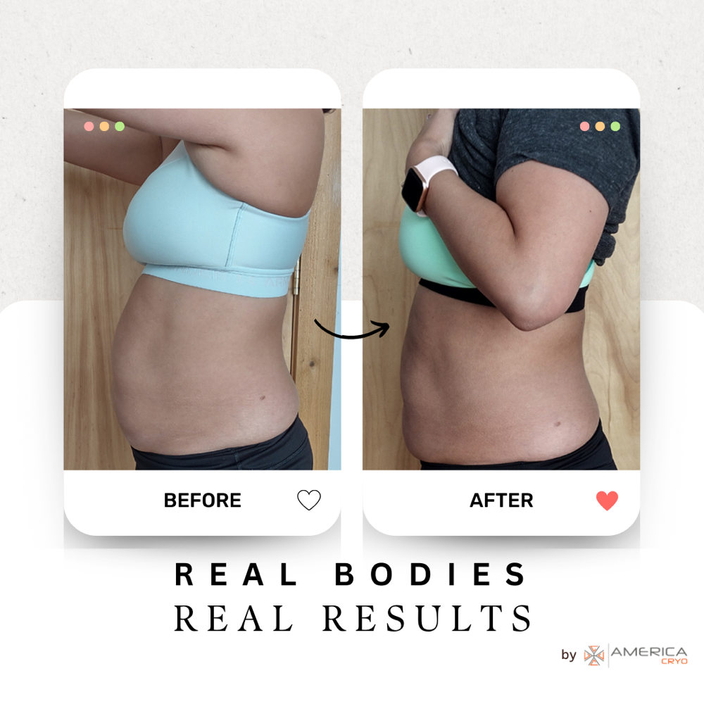 Cryo Slimming Advance