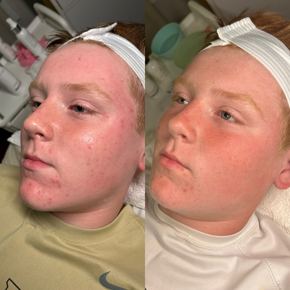 Mandelic Peel