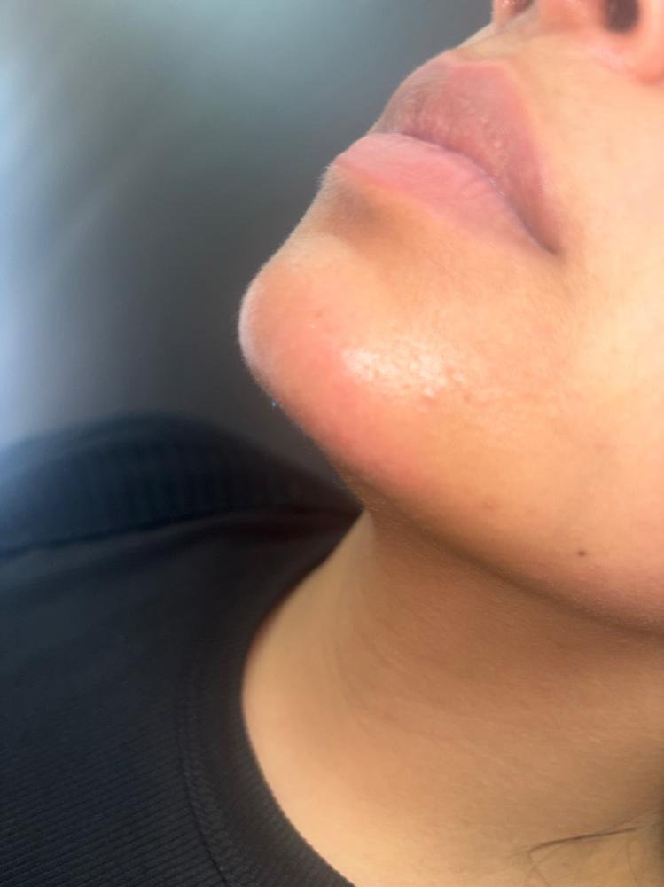 Chin Wax at Glogetteresthetics in Warwick, RI