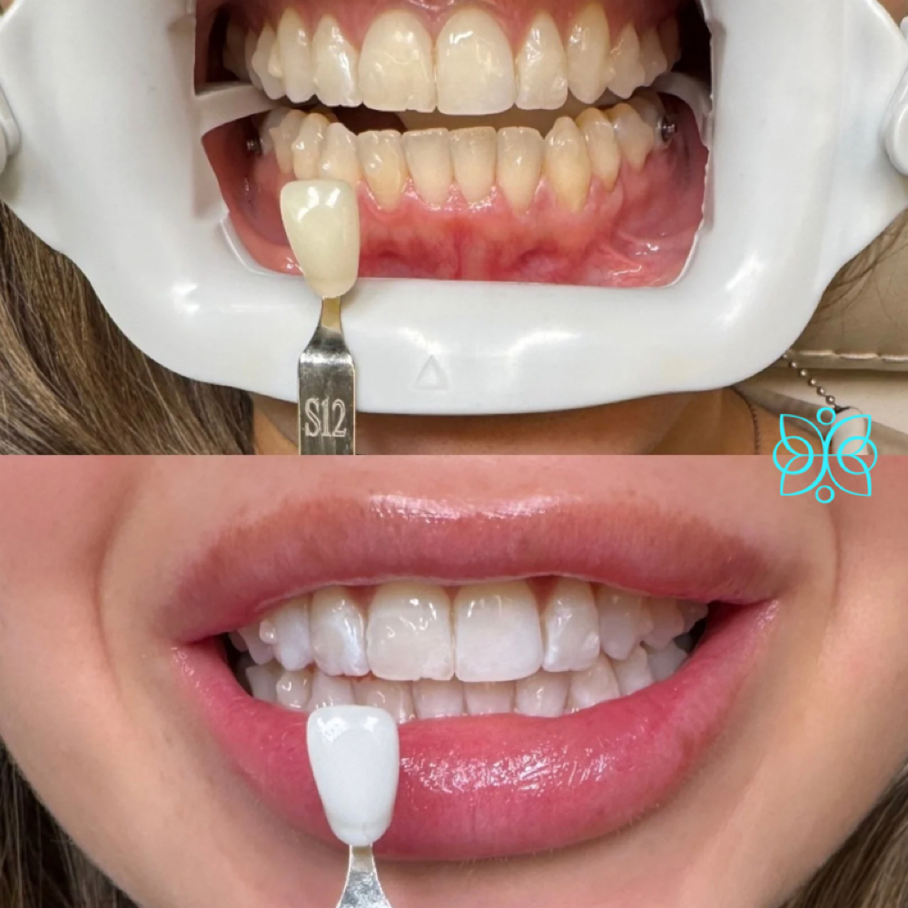 30 Min Express Teeth Whitening at Utopia Beauté in El Paso, TX