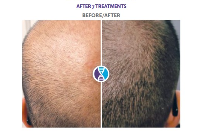 Procell Therapies Hair Package