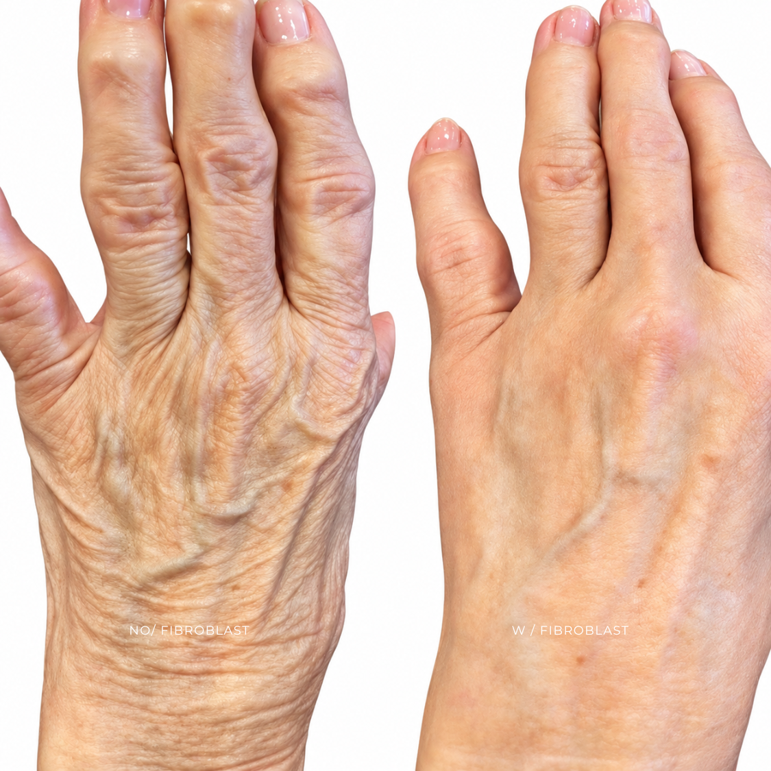 FIBROBLAST | MANOS at EROXSPA in Houston, TX