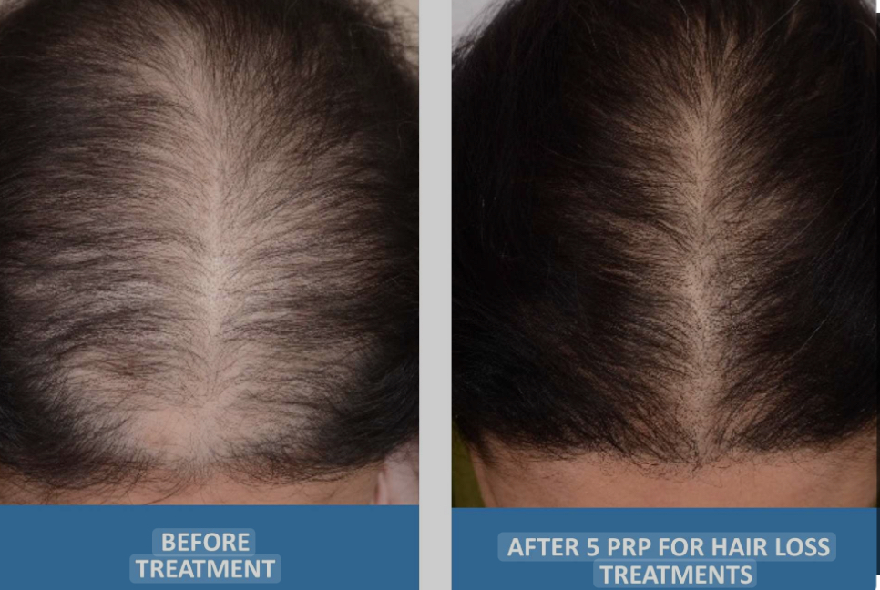 SilkScalp Therapy (PRP Therapy)