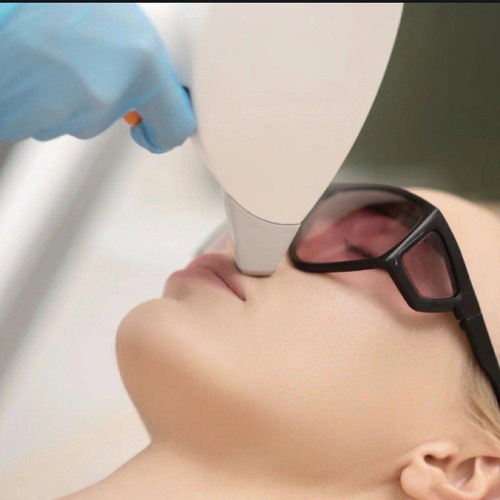 Bozo/Bigote-Depilacion Laser at Gigi’s Beauté LLC in Lanham, MD