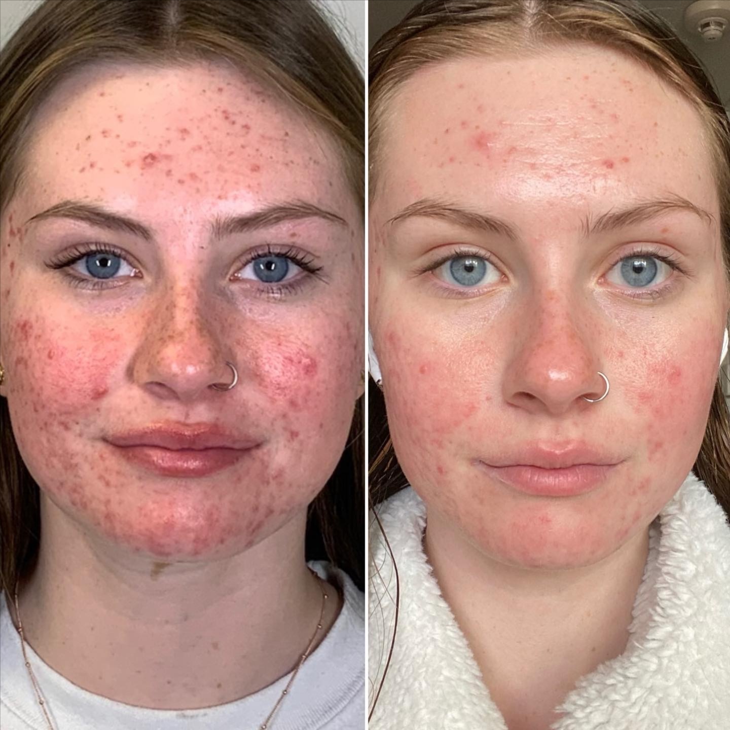 Acne Bootcamp Consultation at Purely Aesthetic in Phoenix, AZ
