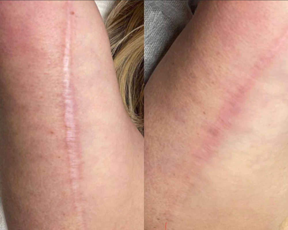 Microchabelling Body /surgicalScars