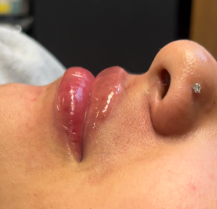Micro Needle Lip Filler