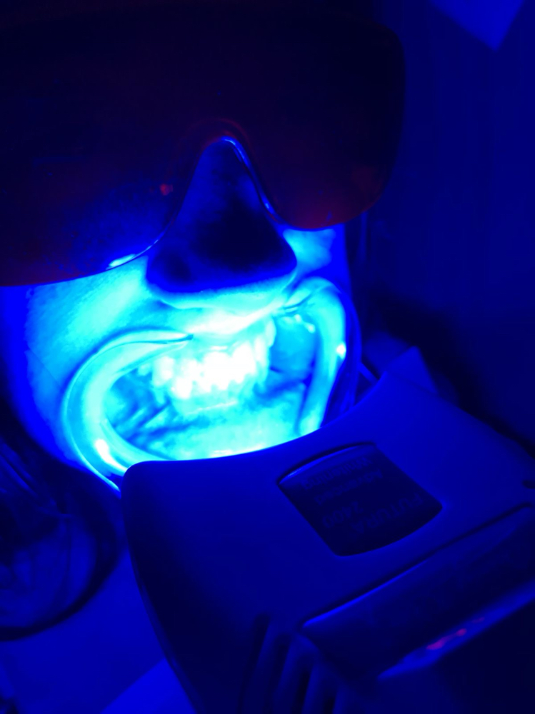 Teeth Whitening 1 hr