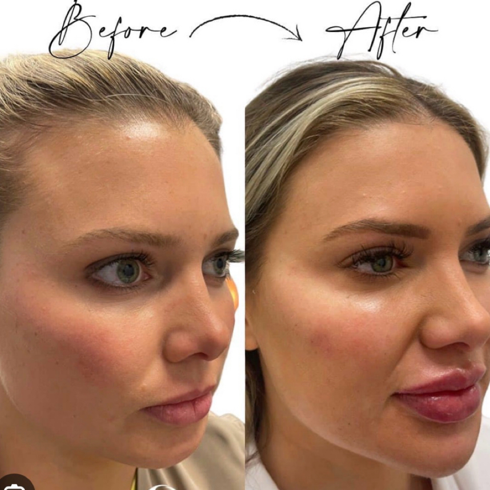 Facial Balancing at Endless Beauty Aesthetics in El Paso, TX