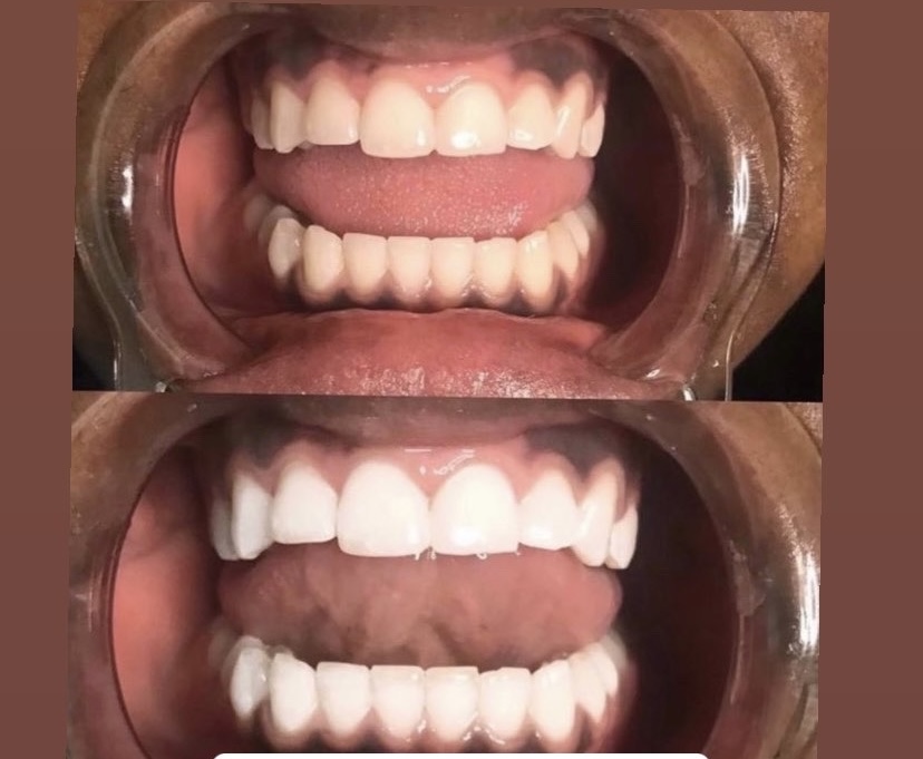 Teeth  Whitning 30 Min