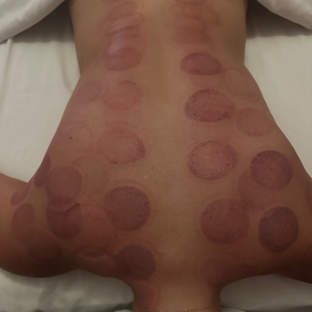 Cupping Add-on at Mystic Veil Massage in Arlington, WA