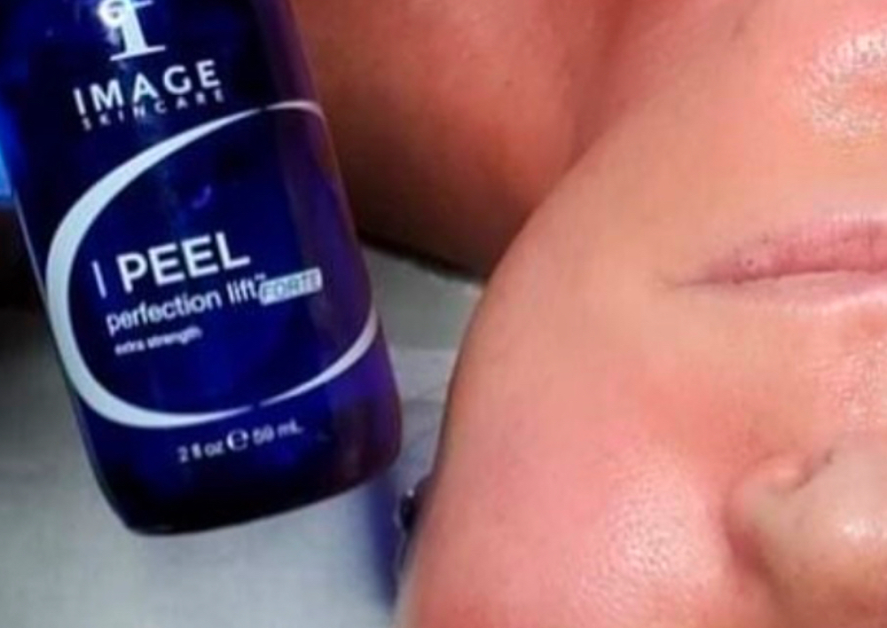Chemical Peel