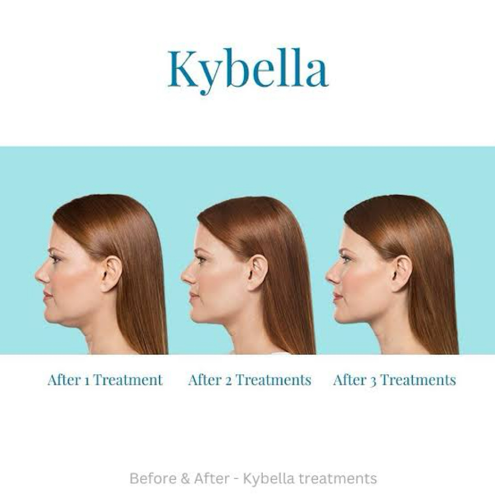 Kybella at Athena Med Spa in San Antonio, TX