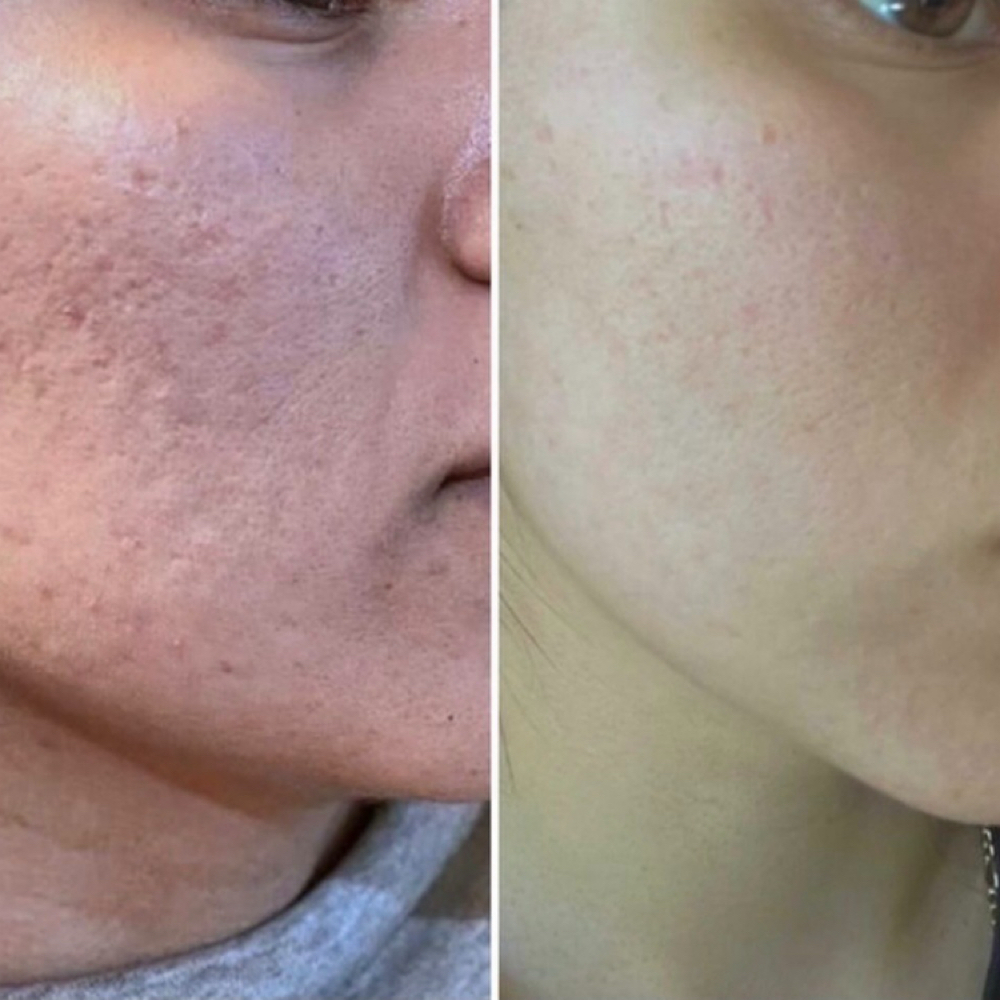 Microneedling + Casmara at La Vie Makeover Studio in Elmwood Park, NJ