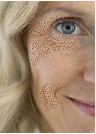 Plasma Fibroblast | Skin Tightening