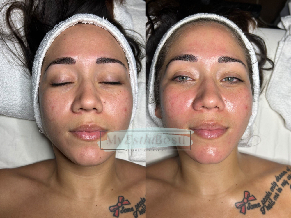 Custom Facial